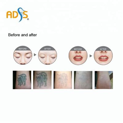 Máquina da remoção da tatuagem do laser de Yag do interruptor do OEM/ODM Q 2 anos de garantia