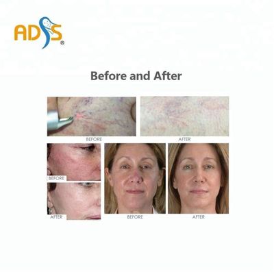 máquina vascular da remoção do laser do diodo 980nm, máquina da remoção da veia da aranha